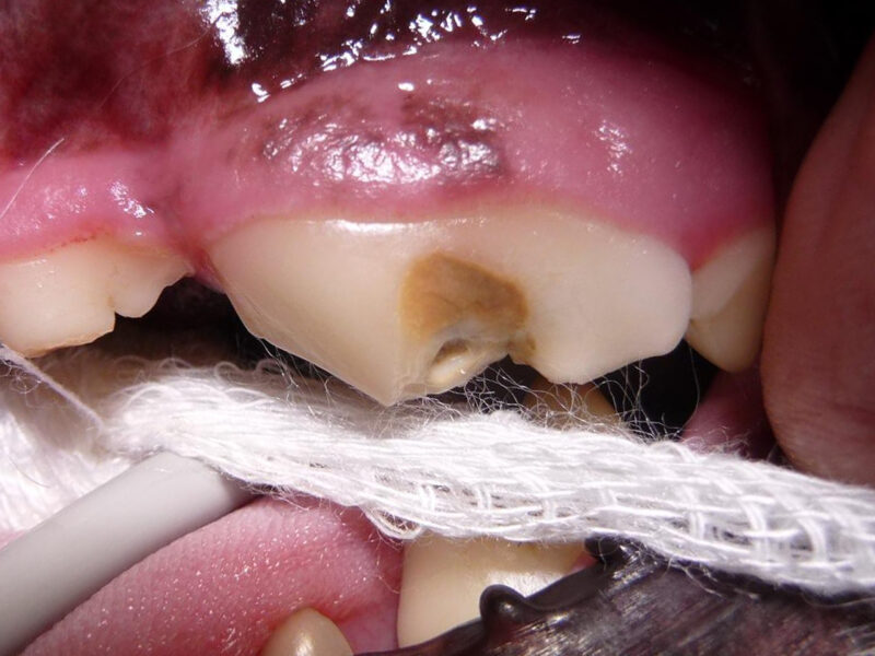 Zahnfraktur Eroffneter Wurzelkanal