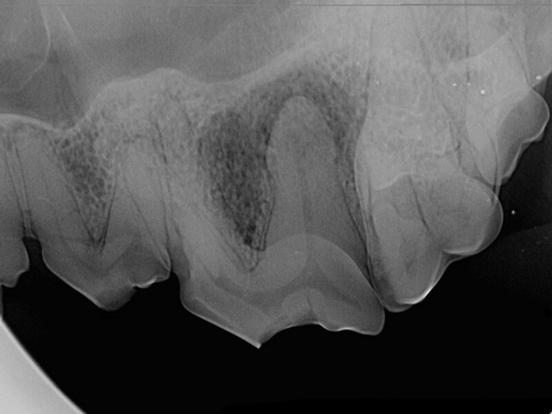 Rontgen Zahnfraktur Infektion Wurzel