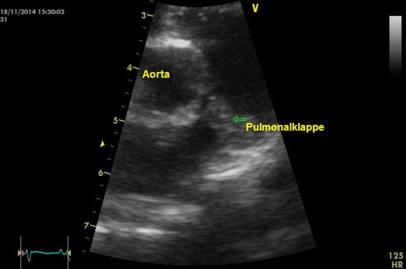 Darstellung der Pulmonalarterie im Ultraschall